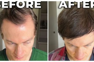 No transplants or drugs: How Bryan Johnson reversed hair loss, greying with nutrition