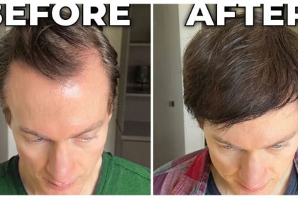 No transplants or drugs: How Bryan Johnson reversed hair loss, greying with nutrition