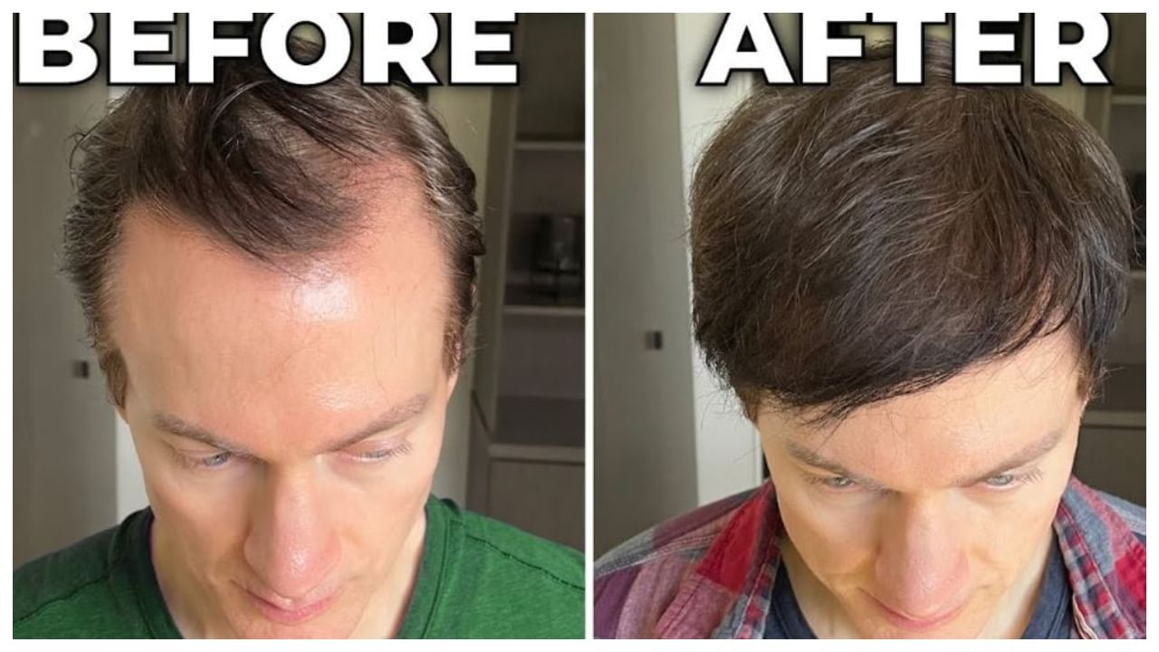 No transplants or drugs: How Bryan Johnson reversed hair loss, greying with nutrition No transplants or drugs: How Bryan Johnson reversed hair loss, greying with nutrition