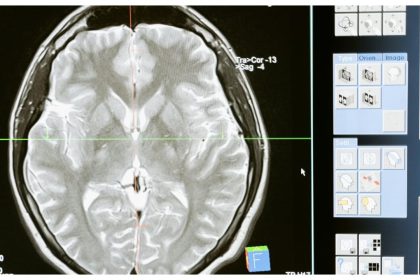 What is glioma? Neurosurgeon answers all FAQs about the form of brain tumour