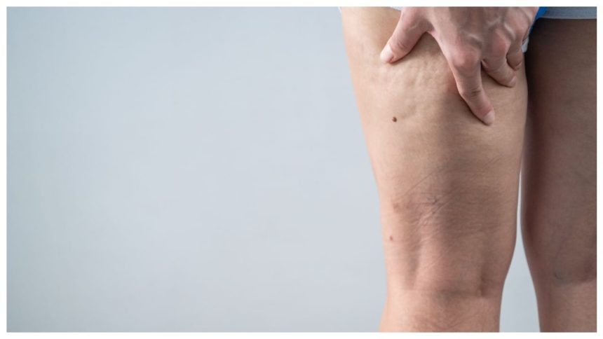 How to get rid of cellulite? From workouts to diet, expert decodes the key 1 How to get rid of cellulite? From workouts to diet, expert decodes the key