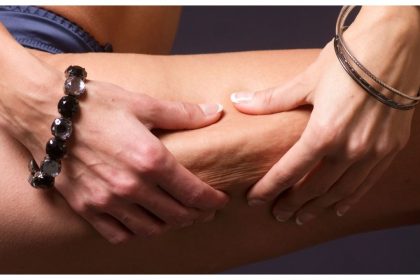 Struggling with cellulite despite a healthy weight? Know the causes