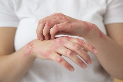 Scalp psoriasis: Expert lists causes; shares tips to treat it from the roots
