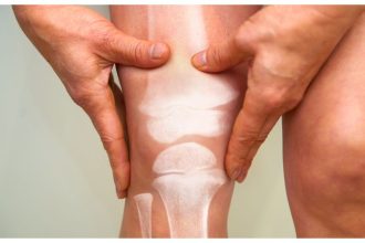 The estrogen association: How hormones influence odds of osteoporosis