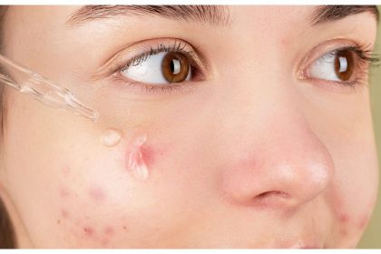 Ever heard of dermatophytosis? Dermatologist answers FAQs about the infection