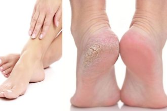Cure cracked heels at home: 5 Remedies for softer, healthier feet