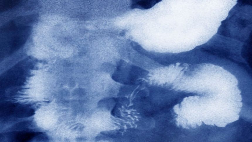 Batteries, razor blade fragments: Hathras teen dies after 65 objects found in stomach 1 Batteries, razor blade fragments: Hathras teen dies after 65 objects found in stomach