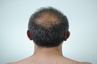 Gone bald within a week: Panic grips 3 Maha villages after residents face hair loss