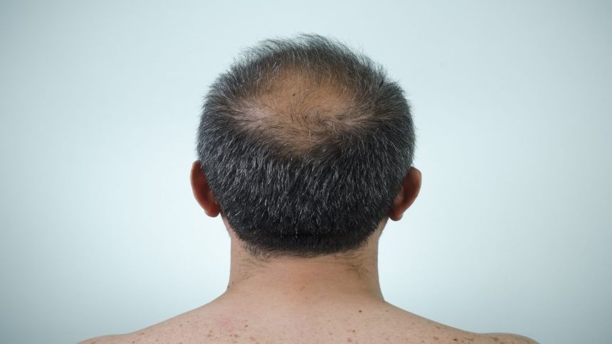 Gone bald within a week: Panic grips 3 Maha villages after residents face hair loss