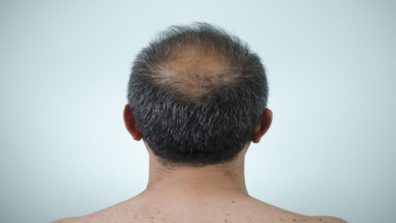 Gone bald within a week: Panic grips 3 Maha villages after residents face hair loss
