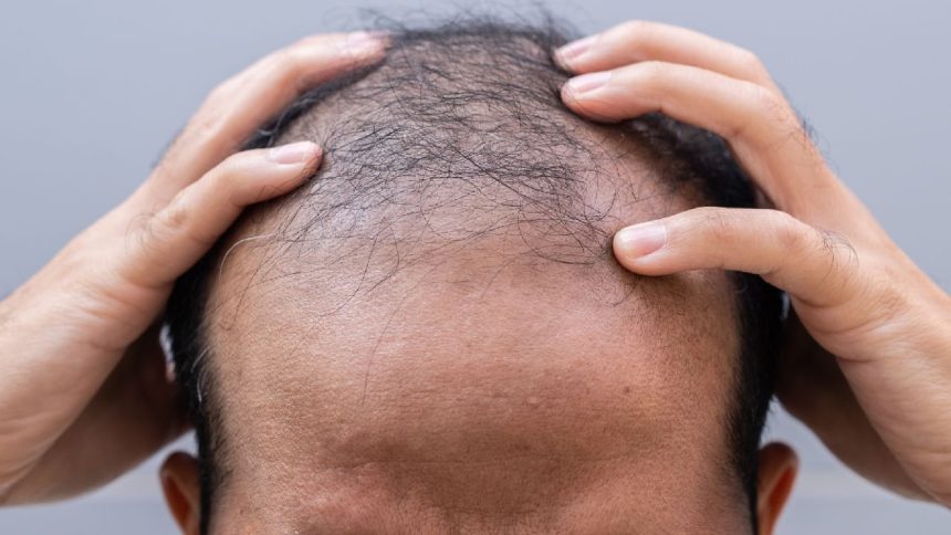 Medical report reveals reason behind rapid hair loss cases in Maharashtra’s Buldhana